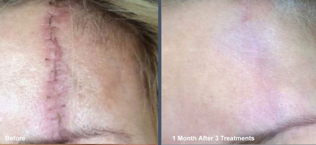 Images of Surgical Scars Before and After Scar Treatment at Rejuvience Med Spa Scottsdale