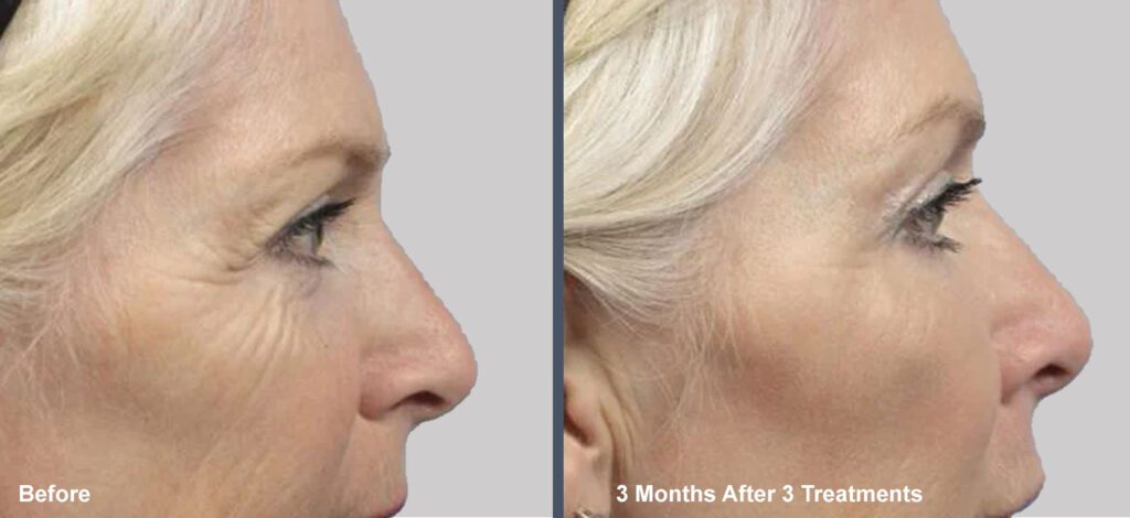 Venus Viva skin resurfacing in Scottsdale before and after images