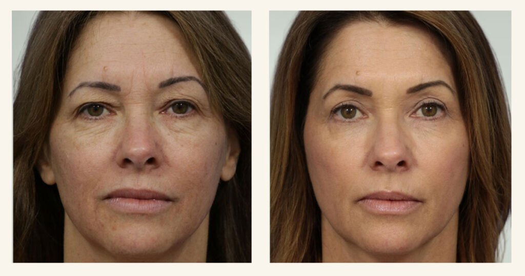 Images of Rejuvience Med Spa Age Repair 4-D treatment before & after
