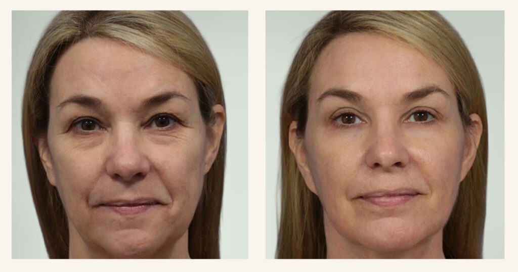 Images of Rejuvience Med Spa Age Repair 4-D treatment before & after