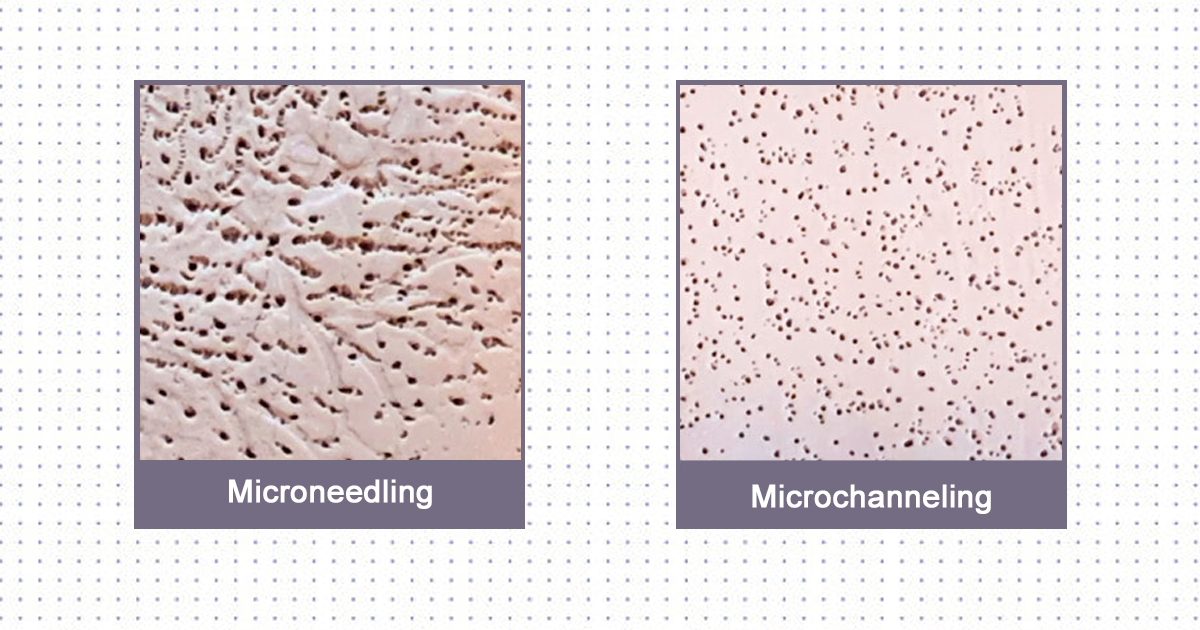 An image of Microneedling and Microchanneling controlled injuries at Rejuvience Med Spa in Scottsdale, AZ