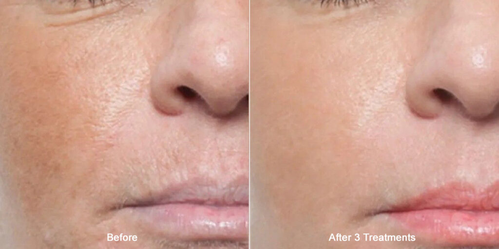 Before and after images of microneedling with exosomes treatments at Rejuvience Med Spa in Scottsdale, AZ