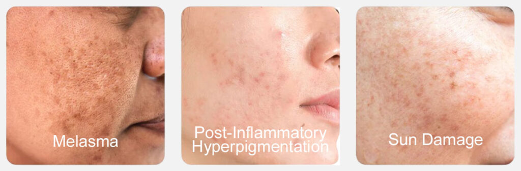 three skin images, one with melasma, one with post-inflammatory hyperpigmentation, one with sun damage
