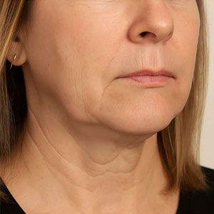 An image of a woman with sagging jowls and neck skin