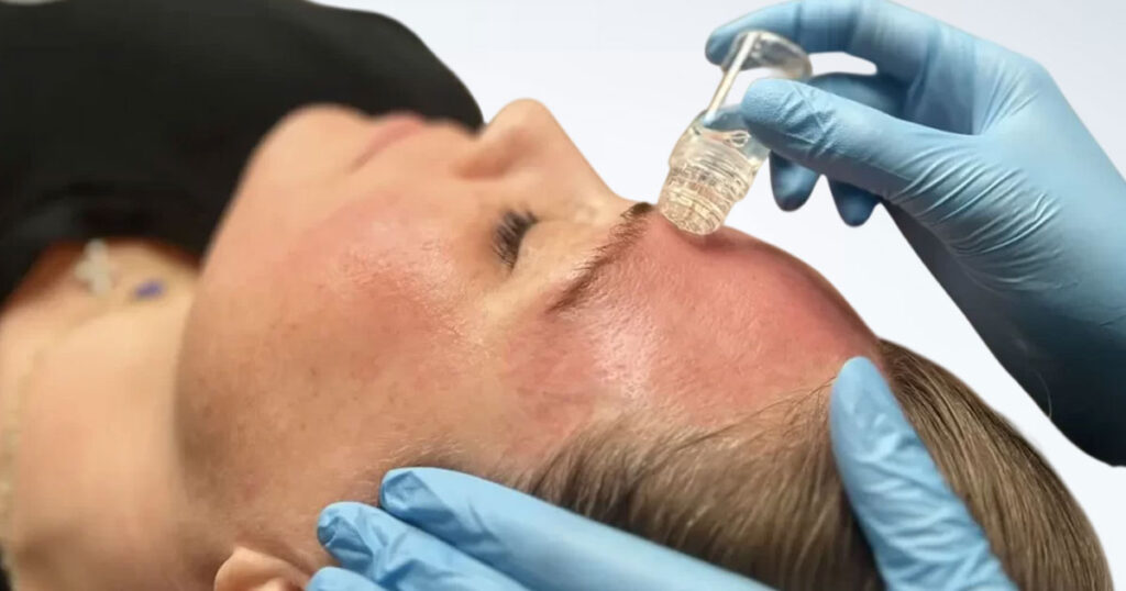 Image of a person receiving a stem cell microinfusion facial treatment with a device applied by a gloved hand.