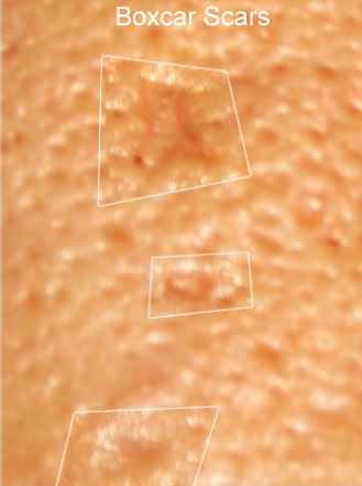 An image of Boxcar Acne Scars that Rejuvience Med Spa in Scottsdale Treats