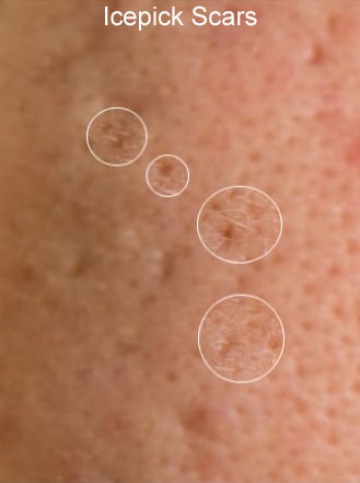 An image of Rolling Ice Pick Acne Scars that Rejuvience Med Spa in Scottsdale Treats