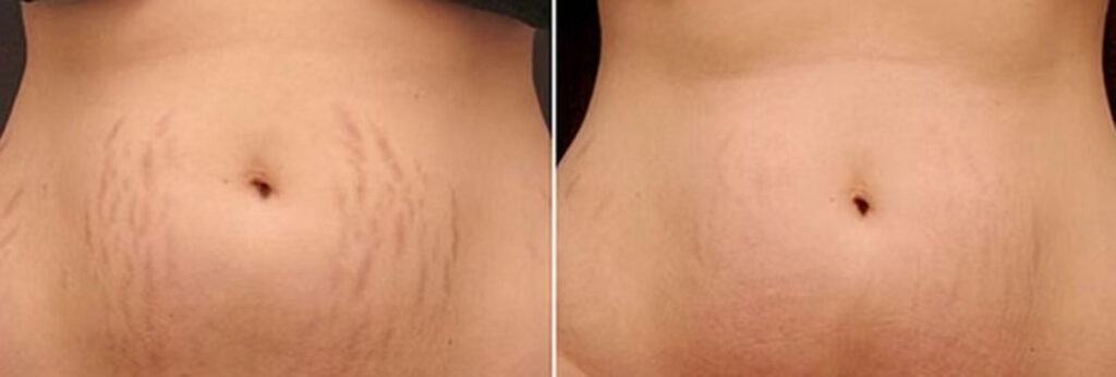 Images of stomach stretch marks before and after stretchmark scar treatment at Rejuvience Med Spa in Scottsdale, Arizona