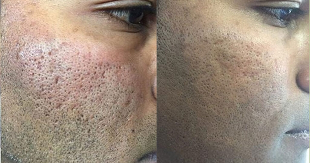 Images of acne scarred skin before and after Venus Viva treatments at Rejuvience Med Spa in Scottsdale, AZ