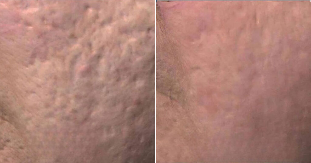 Images of pitted scars before and after Venus Viva RF Skin Resurfacing scar treatment at Rejuvience Med Spa in Scottsdale, AZ