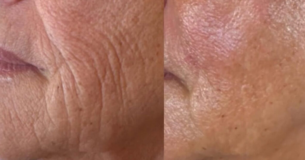Sun damaged skin before and after Venus Viva treatment at Rejuvience Med Spa in Scottsdale, Arizona