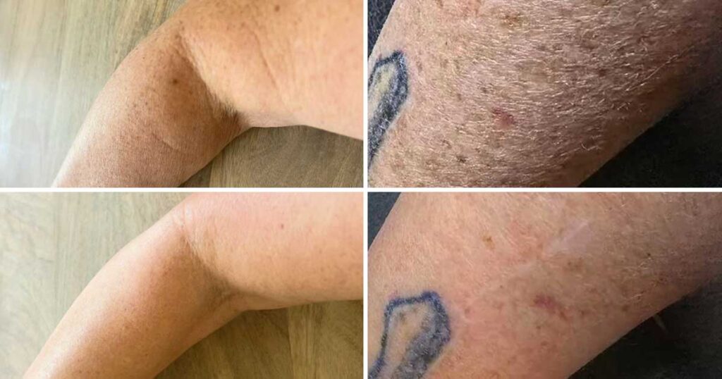 Clinical treatment for crepey arm skin structure showing skin tightening results
