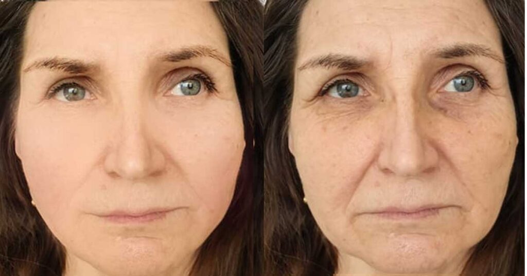 A face before and after taking Ozempic illustrating the sagging and wrinkles from volume loss