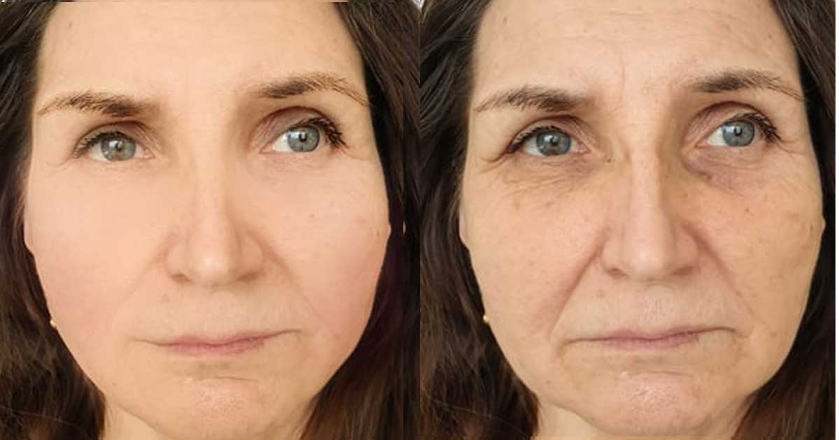 A face before and after taking Ozempic illustrating the sagging and wrinkles from volume loss