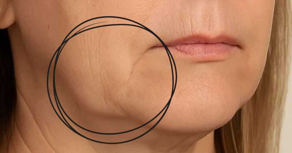The side of a woman's face with jowls circled